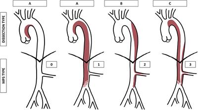 A New Clinically Driven Classification for Acute Aortic Dissection